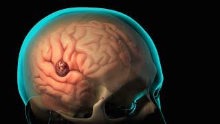 Craniotomy and Craniectomy