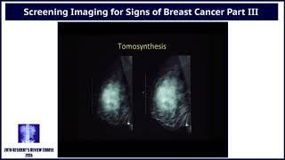 Screening Imaging for Signs of Breast Cancer - Part III