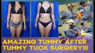 Tummy Tuck  Amazing Results | Dr.Cortes | Houston Plastic Surgeon