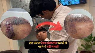 Ultimate Guide to Hair Transplants: Everything You Need to Know!" Awish Clinic