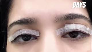 Plastic Surgery in New Delhi, India by Dr. Rohit Krishna  - Eye Lid Correction - Video Testimonial