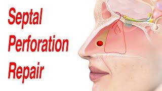 Septal Perforation Repair