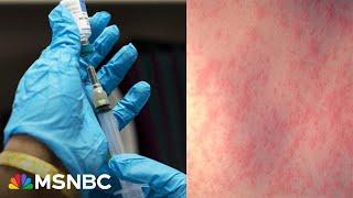 ‘We’re seeing the tip of the iceberg’ in biggest Texas measles outbreak since 1992: Dr. Patel