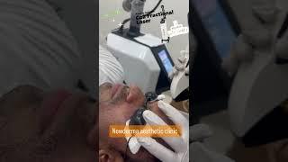 Co2 fractional laser treatment at Mira Bhyander in Newderma aesthetic clinic acne scars treatment