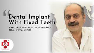 Missing Anterior Teeth? Get Broken Tooth Treatment in Time | Dental Implant Solutions | Royal Dental