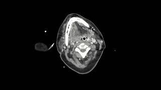 Ventriculoatrial shunt