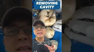 Why it’s Important to Remove a Cavity (Preventing Dental Problems) | View Mobile Dental #shorts