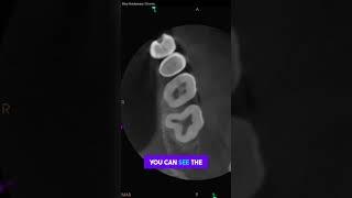 Case Study: Maxillary Second Molar with Four Roots