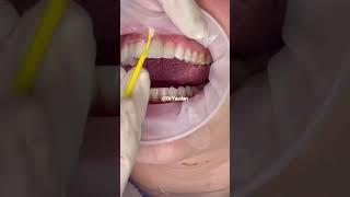 Porcelain veneer procedure | porcelain veneers before and after | Dr. Yazdan | smile transformation