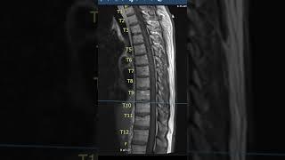 Thoracic Spine MRI