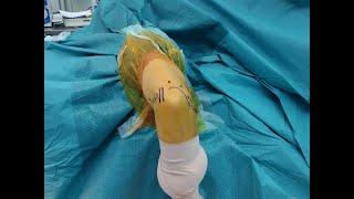 Elbow instability : Arthroscopic LCL reconstruction 2021