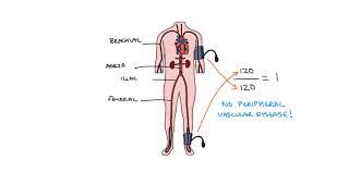 Understanding Ankle Brachial Pressure Index (ABPI) in Peripheral Vascular Disease