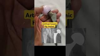 Artificial Ceramic Hip for Damaged Hip Joints#hipjointreplacement #hipfracturerecovery