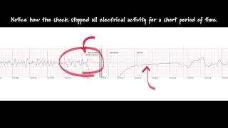 ECG Steve Save | SaveStation