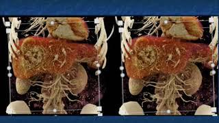 CT and CTA Evaluation of Hepatoma Part 1