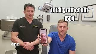 One year results of hair restoration in America. How many grafts?