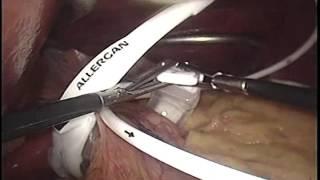 laparoscopic Gastric Banding By Wael Tobar MD