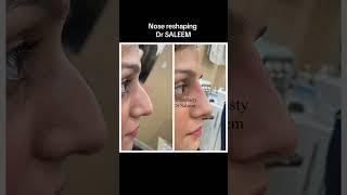 Nose reshaping treatment by dr Saleem. #rhinoplasty #nonsurgicalrhinoplasty #nosejob #drsaleem