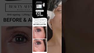 Testimonial Hifu liftera eye lifting treatment  #hifu #eyelift #medispa  #beautybrands #gybaio