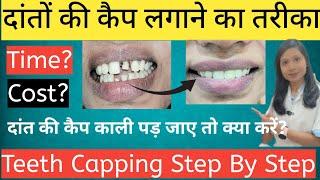 Danto Ki Cap |Lagane Ka Tarika |Cost ? Process? Time ? Teeth Capping Step By Step |Zirconia Cap Cost