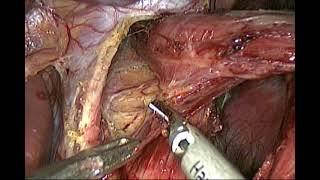 laparoscopic fundoplication  by prof.Wael Tobar