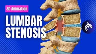 Lumbar Stenosis - 3D Animation