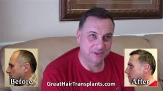 Best Hair Implant Technique In Hoboken, New Jersey - Dr. Brett Bolton