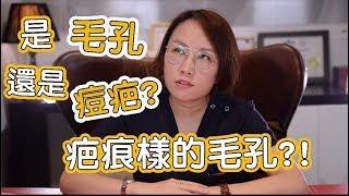 2019年毛孔治療再進化-毛孔也跟痘疤有關嗎？什麼是毛孔樣的痘疤？