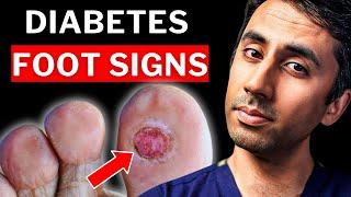 8 Warning Signs Your Feet Give You About Diabetes (Never Ignore These)