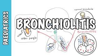 Bronchiolitis (causes, pathophysiology, signs and symptoms, treatment)