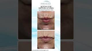 Dynamic Lip Lines Treatments