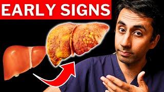 7 Signs of Undiagnosed Liver Disease In Adults