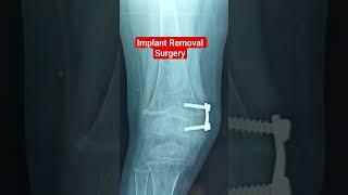Implant Removal Surgery.. Dr Sai Chandra MBBS DNB Ortho Hyderabad