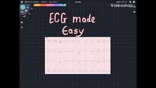 Basics of ECG/EKG