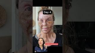 Amazing CO2 Laser Recovery Journey (BEFORE AFTER RESULTS)