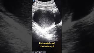Endometrioma/chocolate cyst#ultrasound #imaging #medicalimaging #learning #medicine #viral #doctor