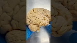 Facial Paralysis & Bells Palsy!