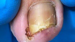 Ingrown Nails Are Inflamed, Be Careful To Cut Off The Sharp Corners【Xue Yidao】