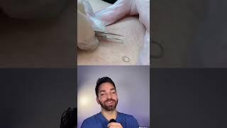 Infinite Ingrown | Doctorly #shorts