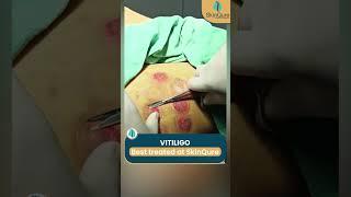 Vitiligo Treatment at @skinqure | Permanent cure for vitiligo