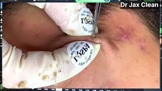 Extreme Pimple Popping So Satisfying Yet So Gross || #pimple #pimplepopping #pimples