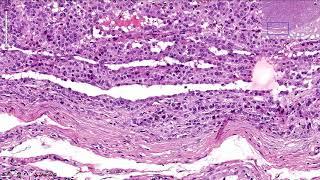 Leydig Cell Tumor - Ovary, Histopathology