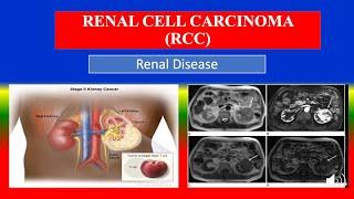 RENAL CELL CARCINOMA (RCC) - Definition, types, causes, pathophysiology,  diagnoses , medicine