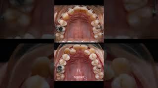 Teeth move with braces #braces #orthodontist #dentist #dentistry #niengrang #dental