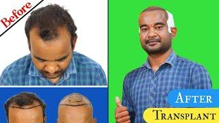 Patient Review Before & After Hair Transplant || Surgery Done By Dr. Ankit Jain