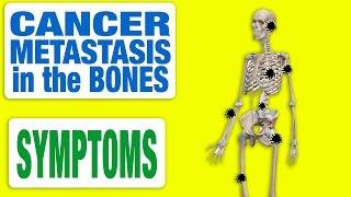 Cancer Metastasis in the Bones - All Symptoms