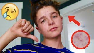 FIXING MY ACNE UPDATE! | Brock and Boston