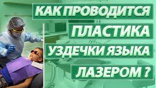 Как проводится пластика уздечки языка лазером?