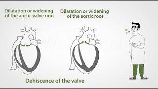 Simptoms of aortic valve insufficiency