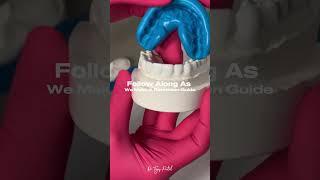 Cosmetic Dentist's Porcelain Veneer Reduction Guide